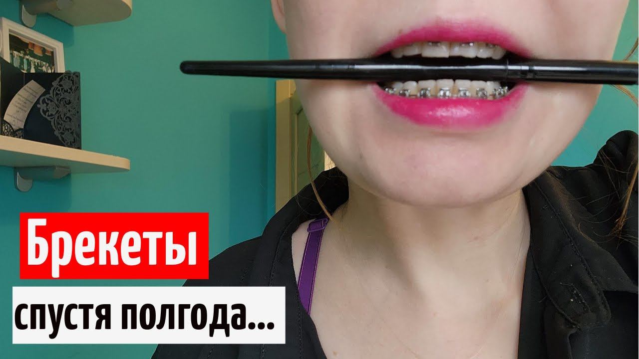 Брекеты минивинты отзыв спустя полгода /Брекеты моя история смотреть онлайн