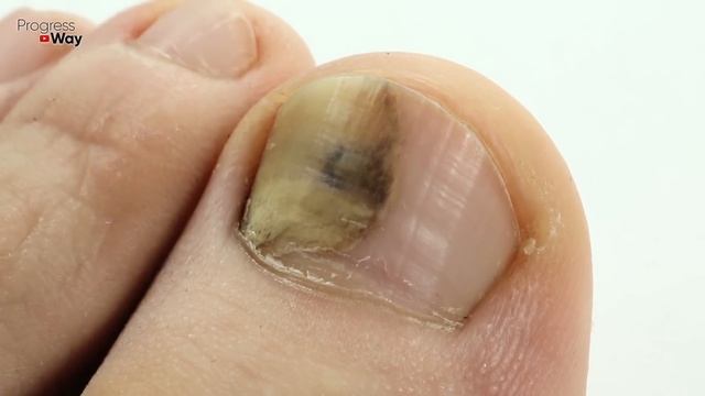 Просто Нанеси Эту ЯДРЁНУЮ Мазь и Она Разъест Весь Грибок с Ногтей! Есть в Каждой Аптеке! смотреть онлайн