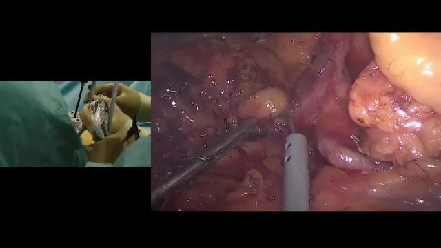 Lap D3 Right Hemi. Yosuke Fukunaga. LIVE. Russian Cancer Research Center 21.10.2016