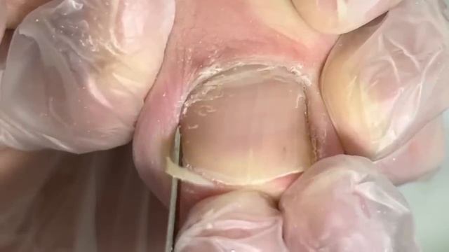 Ingrown Armor Like Horns! Dig Out The Nail【Crazy Pedicure Room】
