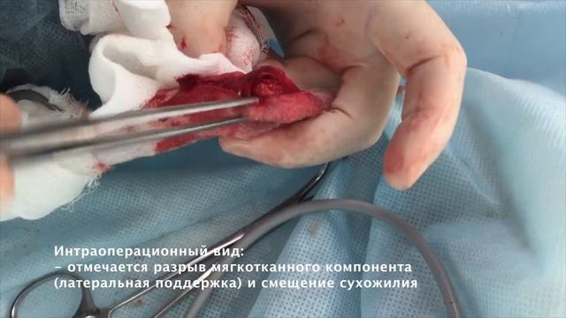 Глава1 Вывих сухожилия поверхностного пальцевого сгибателя смотреть онлайн
