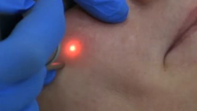 Удаление сосудов на лице лазером смотреть онлайн