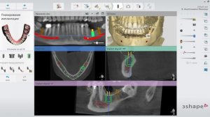 Моделирование навигационного хирургического шаблона в 3Shape