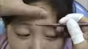 Как сделать соскоб со лба, чтобы найти клещей demodex