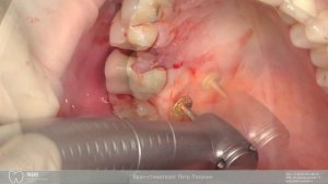 Установка имплантата Hi-Tec. Закрытый синус-лифтинг. Закрытие рецессии.