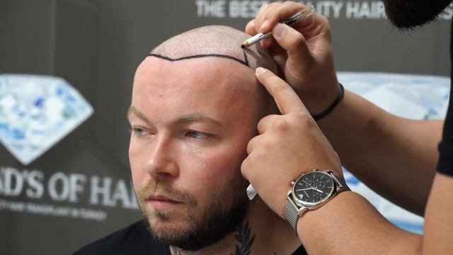 SASCHA'S HAIR TRANSPLANTATION JOURNEY / FROM UNITED KINGDOM смотреть онлайн