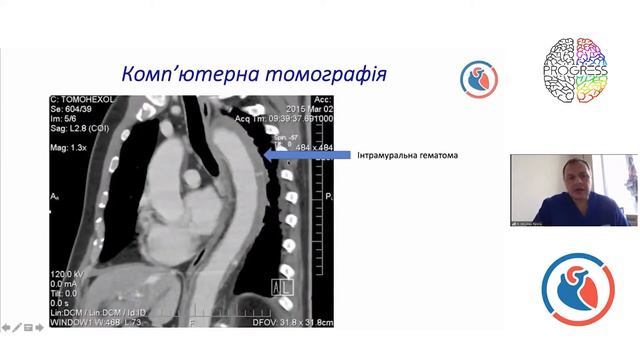 Aortic Dissection Awareness Week 2020 - Кравченко Віталій Іванович смотреть онлайн