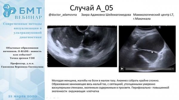Объемные образования яичников. O-RADS с точки зрения УЗИ