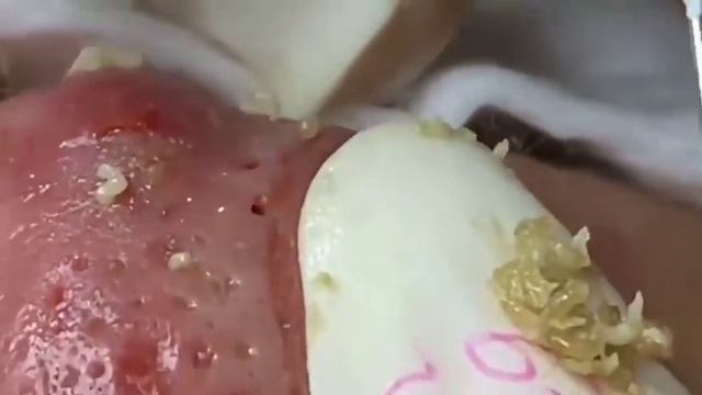 Удаление угрей на лице