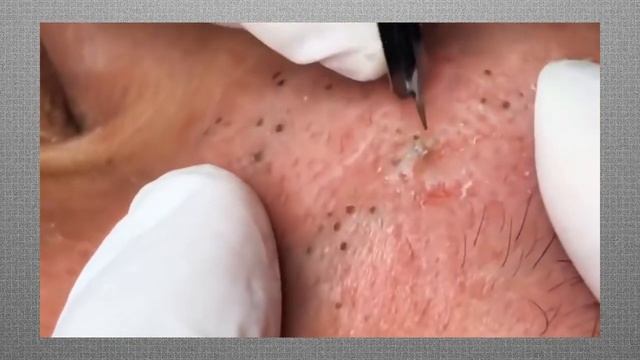 УГРИ ПРЫЩИ ! ДАВИМ ЖИРНЫЕ ЧЕРНЫЕ ТОЧКИ