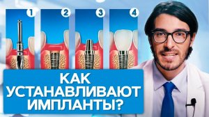 Как устанавливают импланты? Как поэтапно устанавливают импланты, какие результаты и рекомендации?