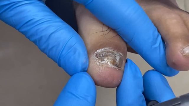 Pedicure Tutorial：bad Nail Fungus Treatment【Pedicure Master Lin Jun】