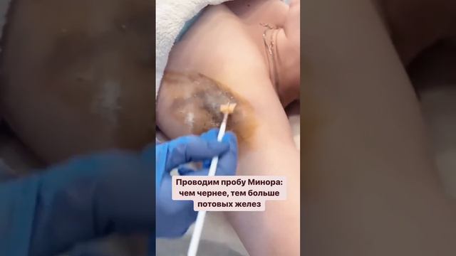 Гипергидроз - повышенная потливость. Лечение гипергидроза ботоксом. Косметолог, Санкт-Петербург. смотреть онлайн
