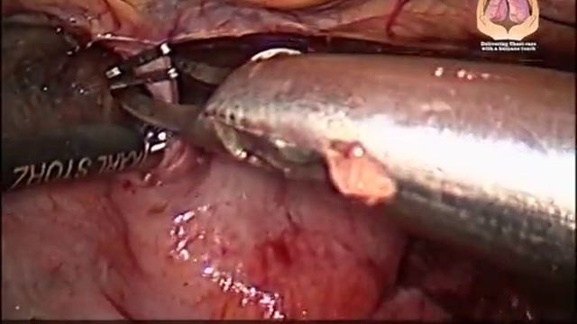 Thoracoscopic (VATS) Excision of Anterior Mediastinal Mass with Prericardial Resection смотреть онлайн