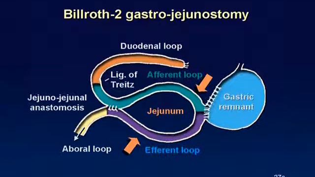 01 Billroth 2 Reconstruction Animation