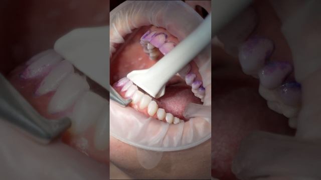 Отзыв пациентки после чистки зубов на аппарате Prophylaxis Master EMS смотреть онлайн