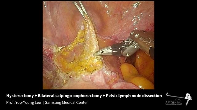 Hysterectomy & Bilateral salpingo-oophorectomy & Pelvic lymph node dissection - Prof. Yoo-Young Lee смотреть онлайн