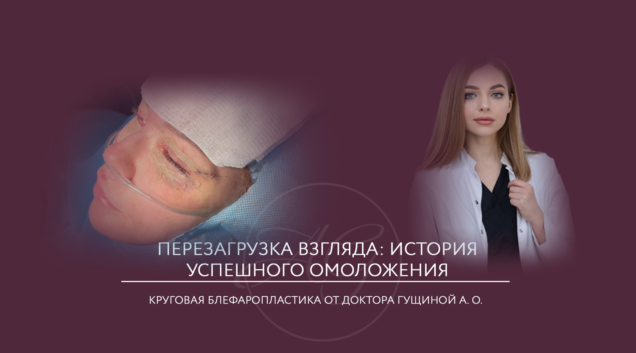Пластика верхних и нижних век | Круговая блефаропластика смотреть онлайн