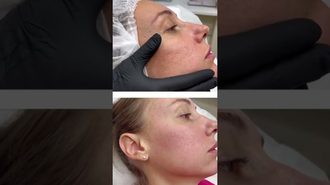 Лазерная шлифовка/ #пилинг + игольчатый #рфлифтинг смотреть онлайн