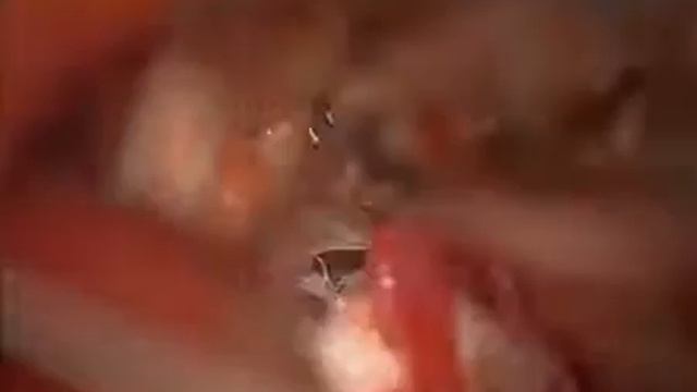 Микроваскулярная декомпрессия смотреть онлайн