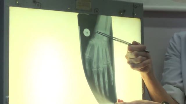 РЕНТГЕНОГРАММА КОНЕЧНОСТЕЙ смотреть онлайн