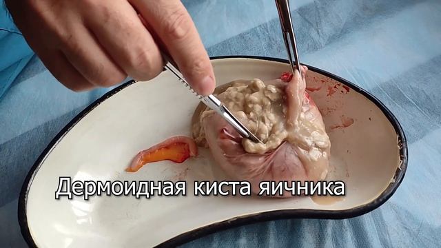 Дермоидная киста яичника смотреть онлайн