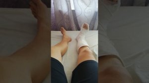 Перелом малой берцовой кости. Часть 1