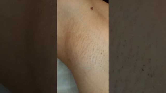 Laser.VIP Лазерная эпиляция в Гае смотреть онлайн