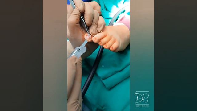 Оперативно лечение на поднокътна екзостоза смотреть онлайн