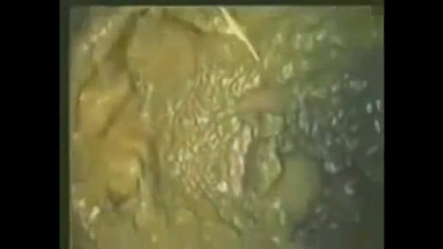 кишечник изнутри здоровый, при кандидозе, паразитах, подагре, при раке и др смотреть онлайн