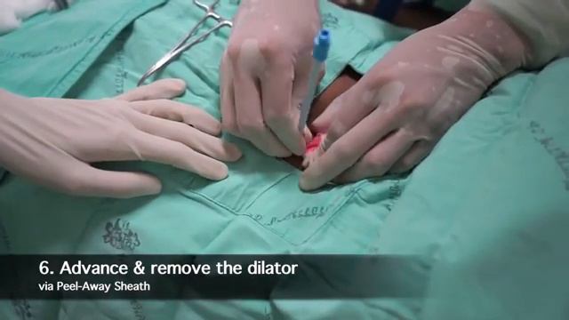 Tenckhoff catheter insertion by Nephrologist смотреть онлайн