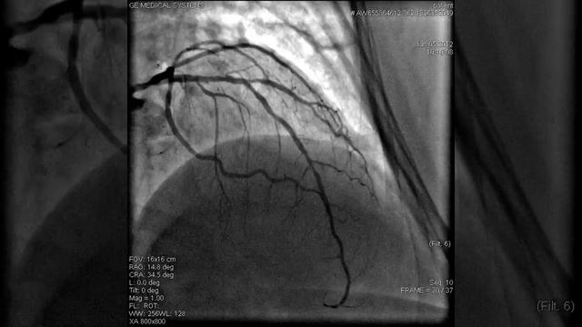 Результаты коронарографии смотреть онлайн