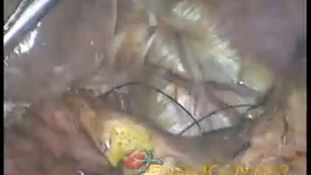 Проксимальная резекция желудка при GIST