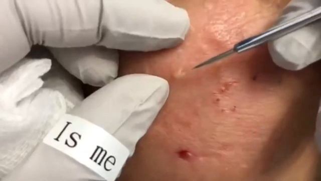 Acne! Огромные угри! Давим! Огромные прыщи!