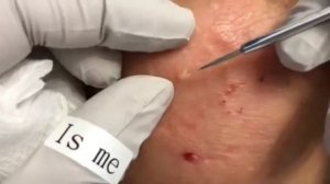 Acne! Огромные угри! Давим! Огромные прыщи!