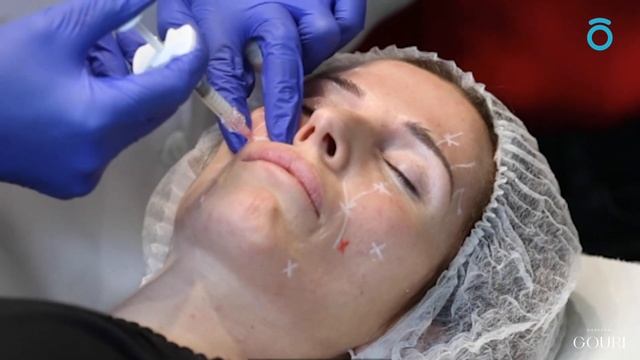 Aplicación De GOURI Por La Dra  Nahid Rouhipour