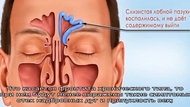 Как бороться с фронтитом