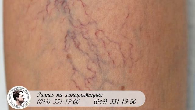 Склеротерапия