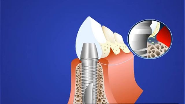 Имплантация Значение профгигиены в имплантологии смотреть онлайн
