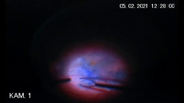 Витрэктомия 27G с удалением эпиретинальной мембраны смотреть онлайн