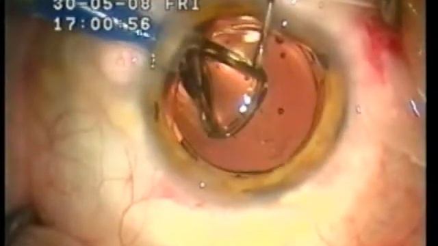 Имплантация составного искусственного хрусталика_1 смотреть онлайн