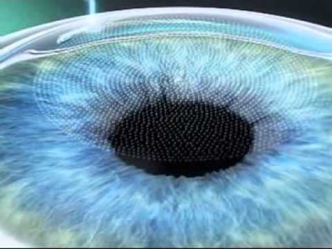 Бесконтактная коррекция зрения. Фемтолазер VisuMax смотреть онлайн