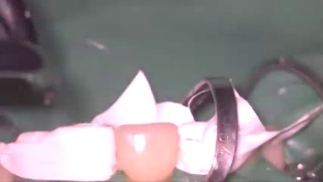 Фиксация винира 11 смотреть онлайн