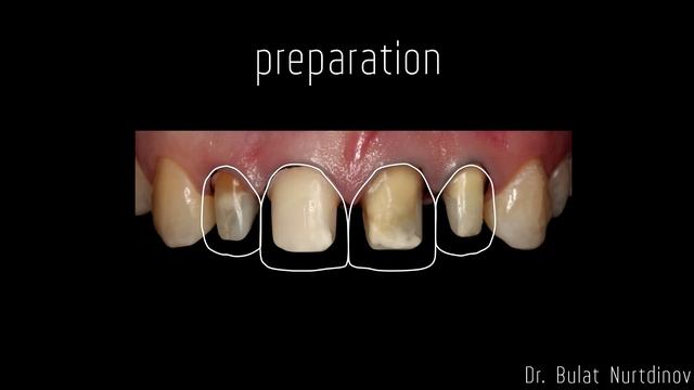 4 керамические коронки - IPS e.max Press сrowns смотреть онлайн