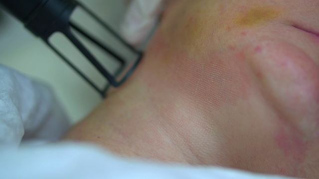 Фракционное лазерное омоложение. смотреть онлайн