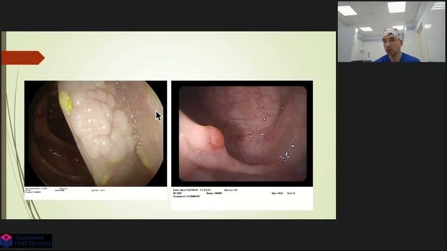 Колоноскопия от подозрения к диагнозу смотреть онлайн