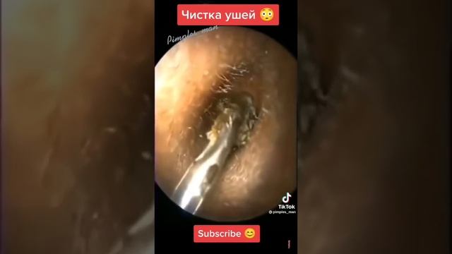 Чистка ушей ? смотреть онлайн
