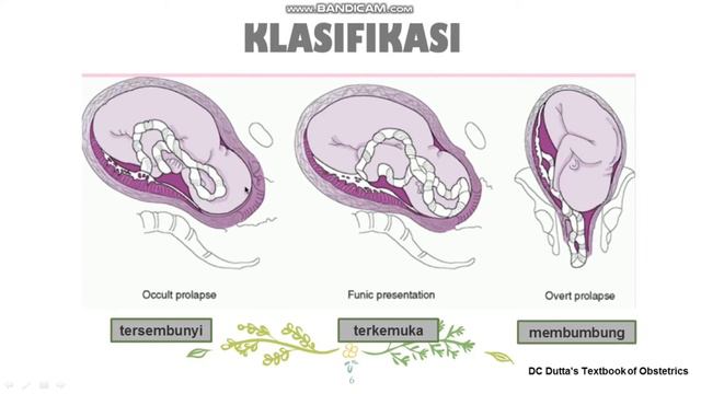 Prolaps tali pusat (Nurhalimatul Mahmudah) смотреть онлайн