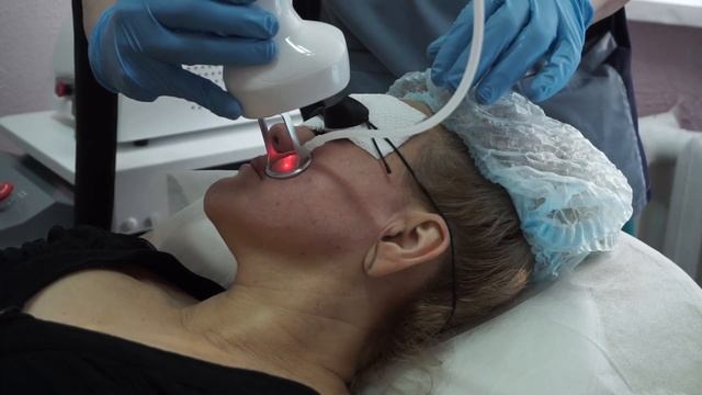 Лазерная Шлифовка Лица: До И После смотреть онлайн