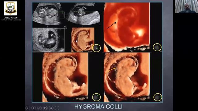 Edwards Syndrome | Ultrasound Approach | Prof. Gilani's Lectures смотреть онлайн